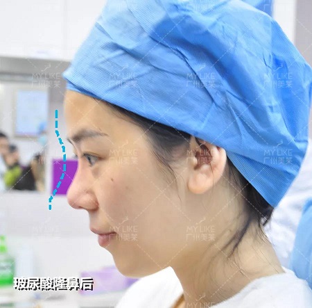 玻尿酸，僅需？80！