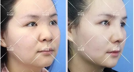 想隆鼻又不想用自己的軟骨，急需一個(gè)男票！