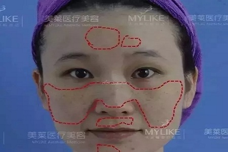五官很好看，為什么不把臉上的斑去掉？