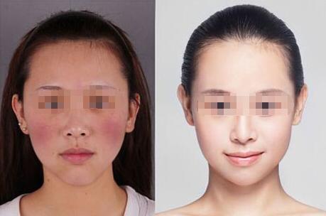 深圳激光去紅血絲多少錢？