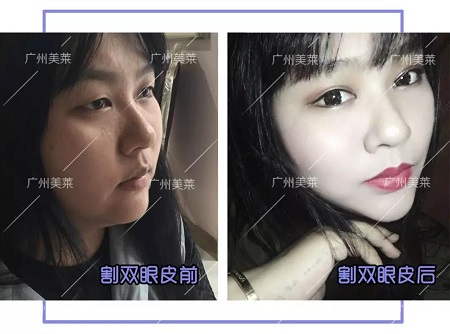 <a href='/ybzx/syp/' target='_blank'><u>割雙眼皮</u></a>后，“眼值”系數(shù)max！睜眼跪！