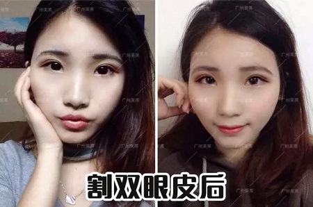 雙眼皮怎樣割，才能美出辨識(shí)度？