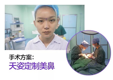 術(shù)后半個(gè)月Get專業(yè)混血臉！可萌可酷美翻了~