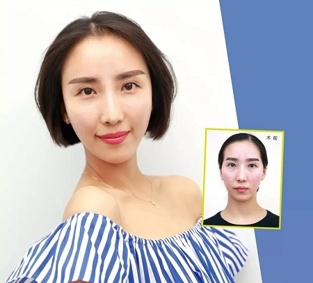 她往臉上注射了點(diǎn)玻尿酸，天天被夸18歲！