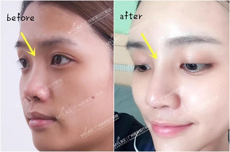 五官精致度欠缺？玻尿酸10分鐘救回來(lái)！