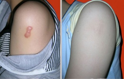 武漢激光去疤痕的方法一般要多少錢(qián)？