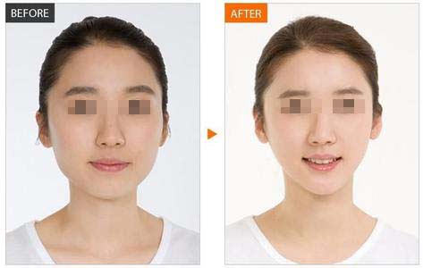 昆明瘦臉打一針多少錢？