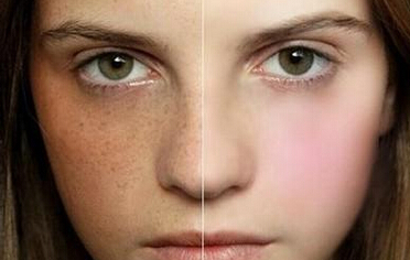 寧波做激光祛斑一次多少錢(qián)？