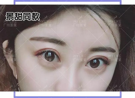 割個雙眼皮，居然成景甜2.0？