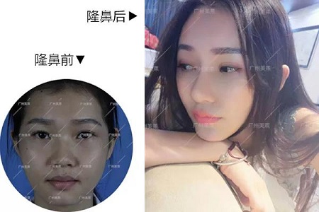 你的臉型，適合直鼻or翹鼻？