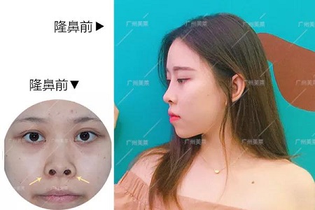 適合直鼻or翹鼻？