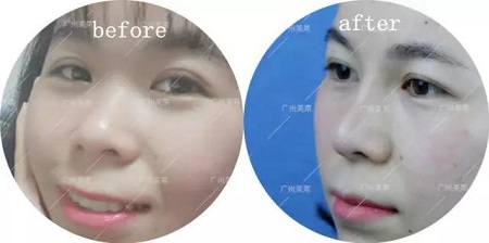 打了2支玻尿酸，她到底變啥樣了？