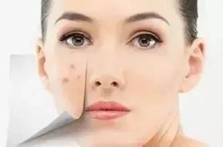 過度熬夜、吃太辛辣，長了痘為啥消不下去！？