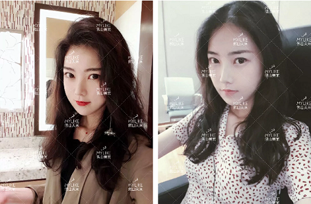 玻尿酸拯救失去的少女感?。?！你也能和娜比一樣美！