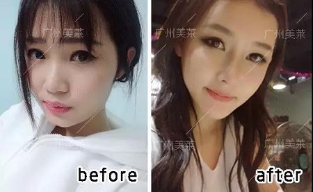 3年隆鼻案例回顧！她們用啥材料？隆了多少mm？