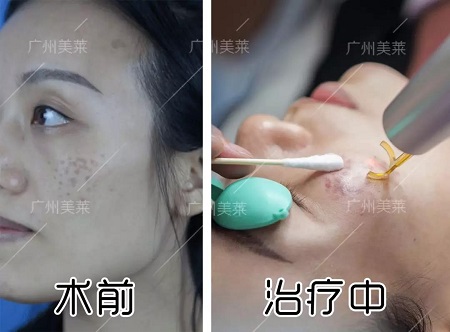 職場上的女強人，偏偏擺不平臉上這斑斑點點...