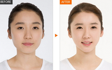 武漢瘦臉會(huì)有后遺癥嗎？