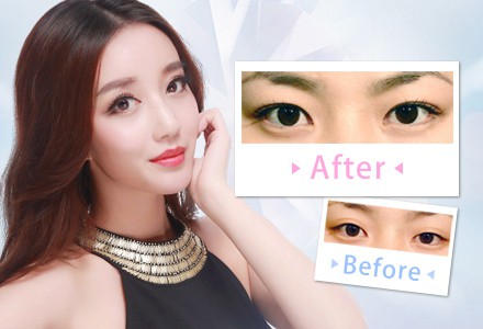南京做埋線雙眼皮多久能消腫？