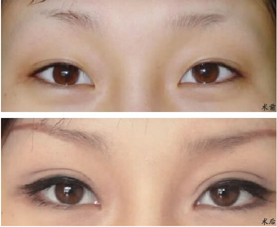 南京做埋線雙眼皮多久能消腫？