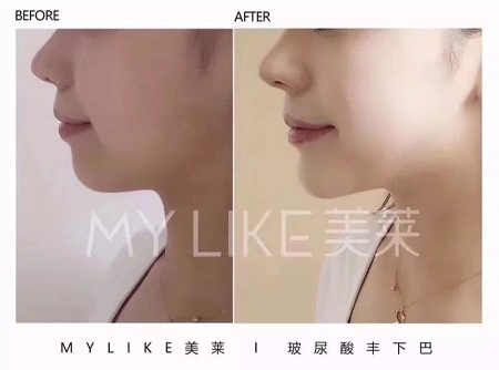 沒想到！除了瘦臉“它”也能瘦臉，而且效果超贊！