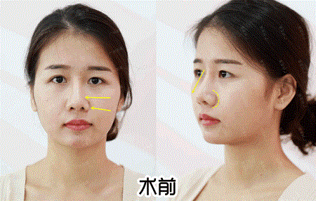 換對(duì)鼻子宛如換了一張臉，