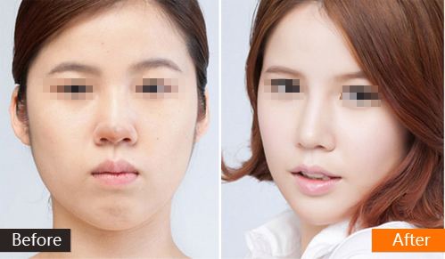 南京隆鼻整形失敗怎么辦？