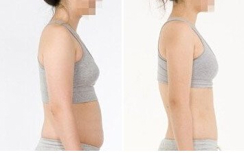 寧波哪里抽脂好？價格怎么樣？