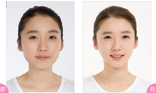 武漢臉部吸脂多少錢？