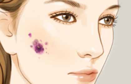 重慶去黑痣多少錢？