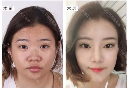 做完鼻整形，顏值逆風(fēng)翻盤！