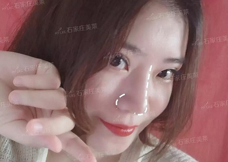 “扁塌鼻”都是潛力股，做完鼻整形，顏值逆風(fēng)翻盤！