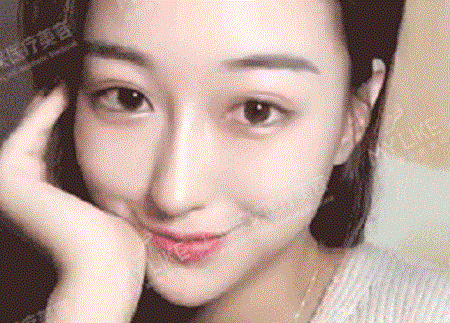 隆鼻害怕假、僵、歪？案例親測示范捏鼻！