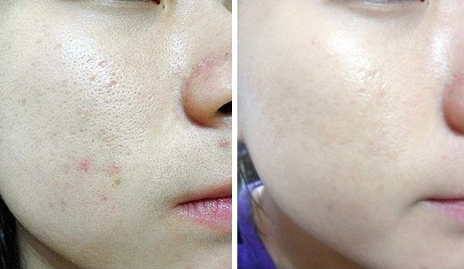 南京光子嫩膚效果好不好？