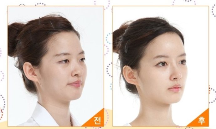 廣州鼻尖整形價格是多少錢？