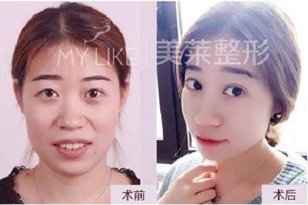 這幾種眼睛割完雙眼皮超美！不信，看她們的術(shù)后效果~