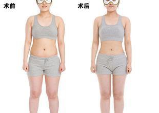 廣州吸脂價錢是多少？