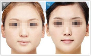 武漢面部吸脂減肥價格？