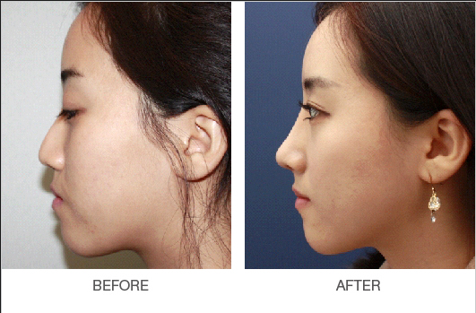 南京假體隆鼻需要多少費(fèi)用？