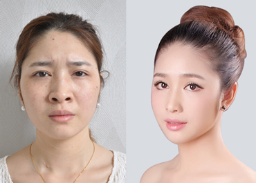 寧波隆鼻多少錢？