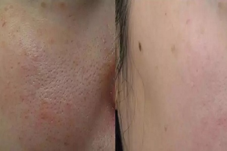 激光收縮毛孔要多少錢