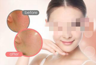 重慶激光美白費(fèi)用多少？