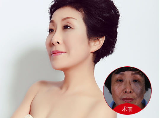 武漢深藍(lán)射頻價(jià)格是多少？