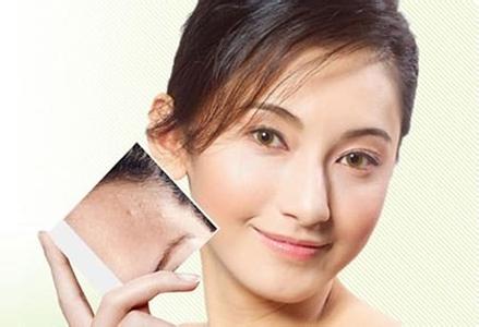 廣州激光祛痘印要多少錢？