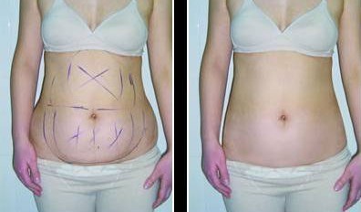 廣州激光抽脂好不好？