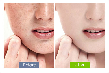 激光祛雀斑需要多少錢(qián)？