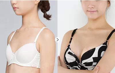 假體豐胸能保持幾年？