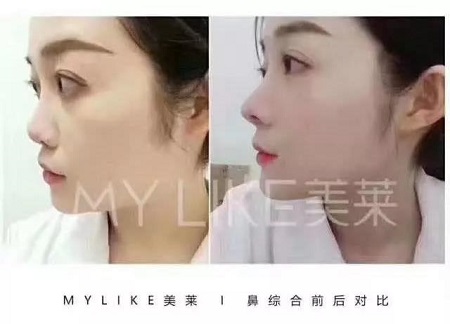 做鼻整形要謹(jǐn)記這些“后遺癥”！