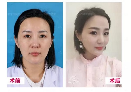 松弛的臉做完*雕，比同齡人足足年輕10歲！