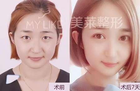 美萊特邀“美眼女神”畢小麗，3月13日親診石家莊美萊。