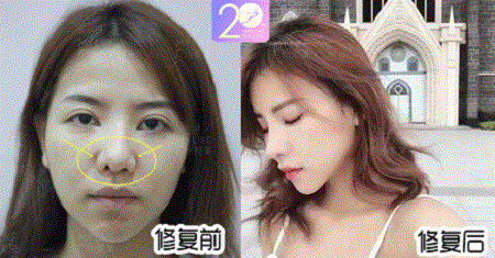 深扒 | 隆鼻價格內幕曝光！水超深！